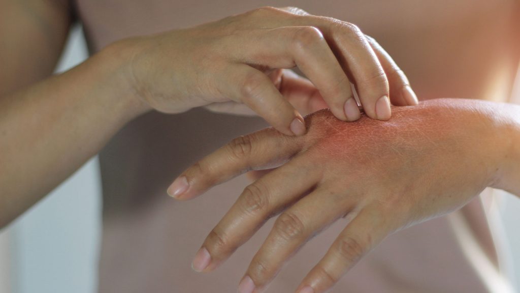 Mulher com as mãos sensíveis e irritadas que apresenta sinais de vermelhidão e comichão